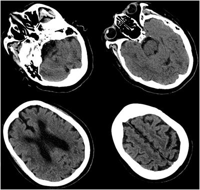 An unusual contrast-induced encephalopathy following percutaneous coronary intervention in patients with cerebrovascular abnormalities: A case report